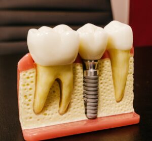 Rich results in google SERP while searching Dental Implants in Mysore
