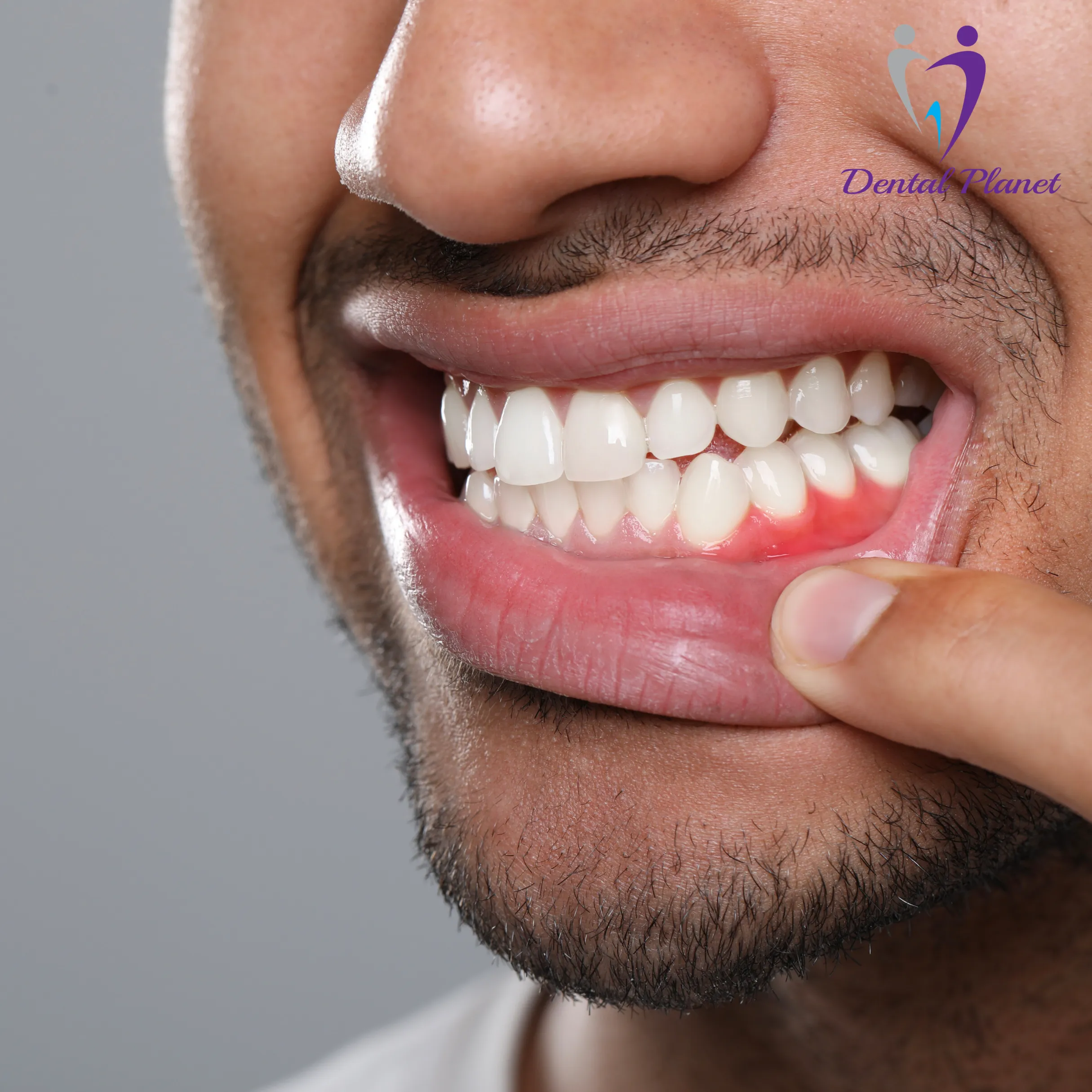 Micro-surgical Periodontal Contouring Dental Planet Mysore