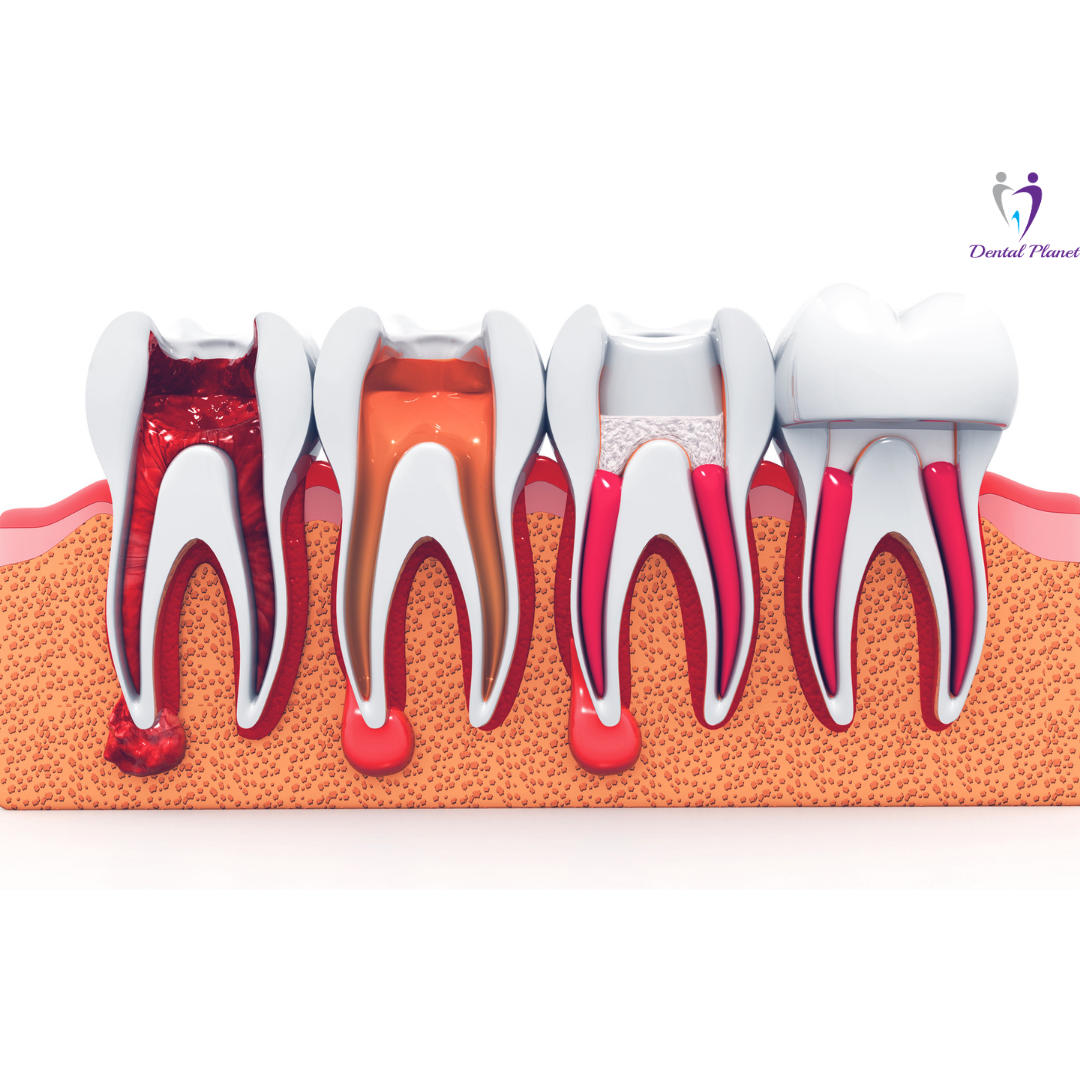 Root Canal Treatment