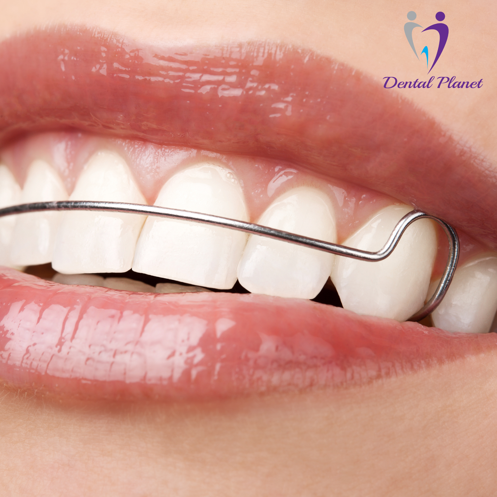 Dental Retainer Wire Close-Up - Dental Planet