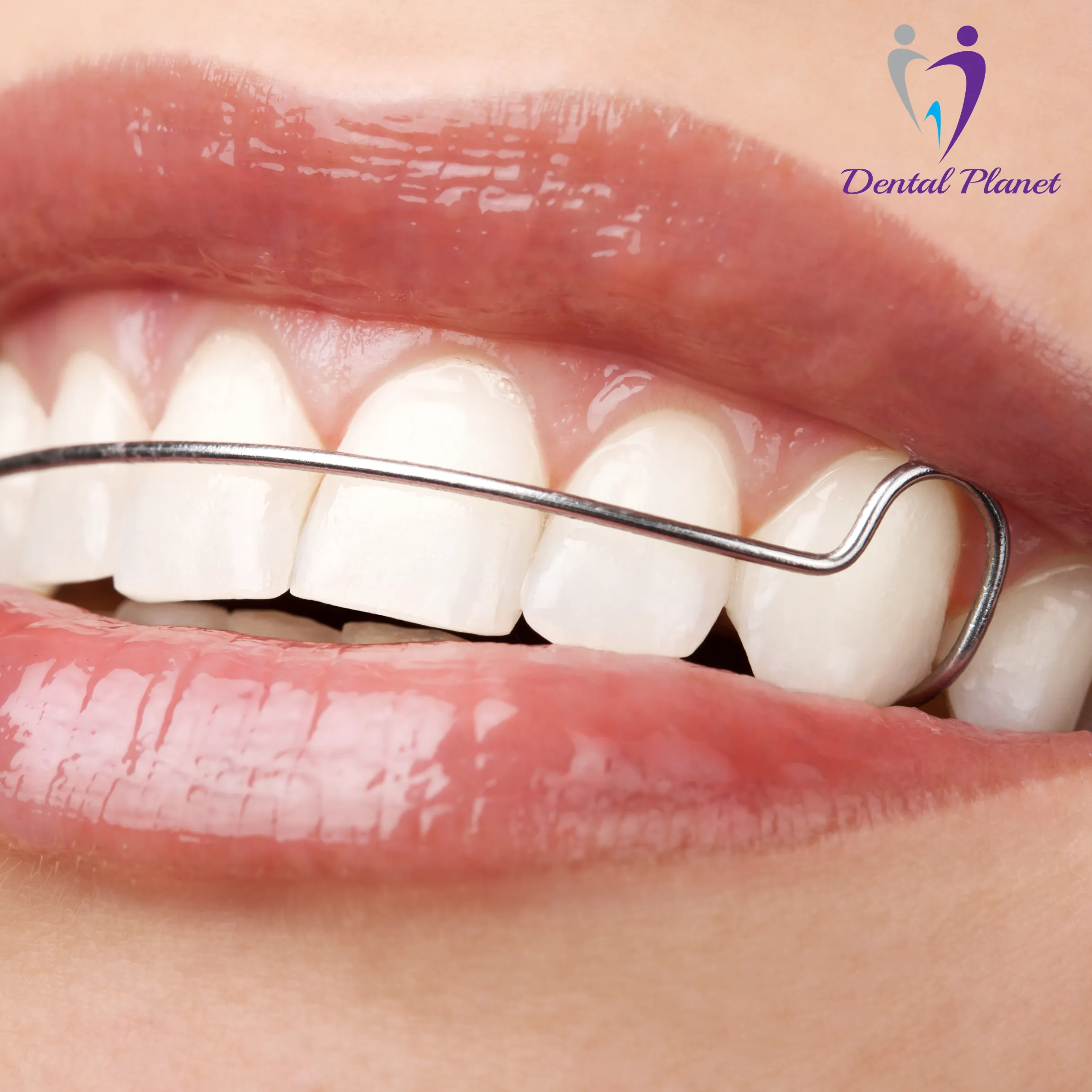 Dental Retainer Wire Close-Up - Dental Planet
