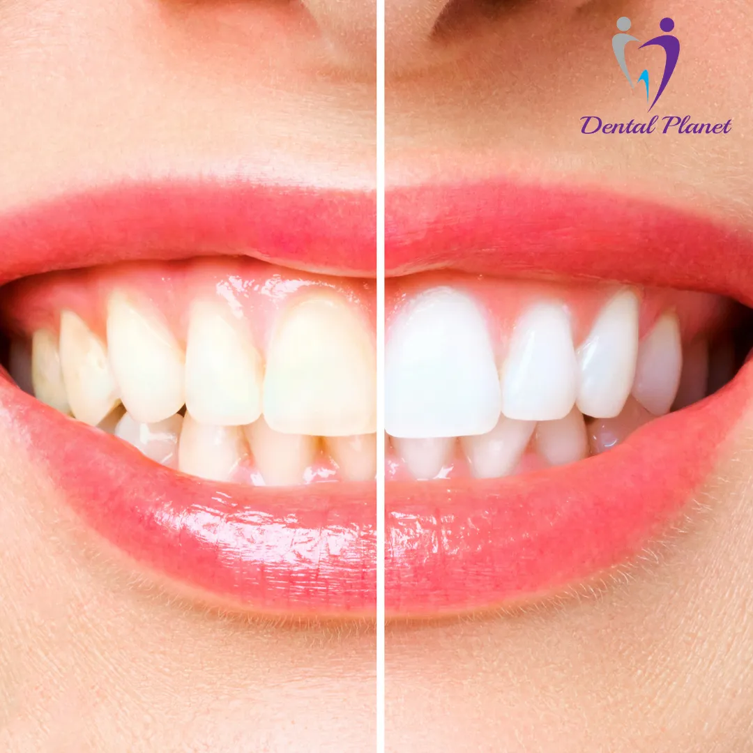 Laser Dentistry