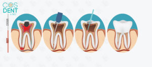 Rich results in google SERP while searching Best Dental Clinic in Mysore Root Canal Treatment