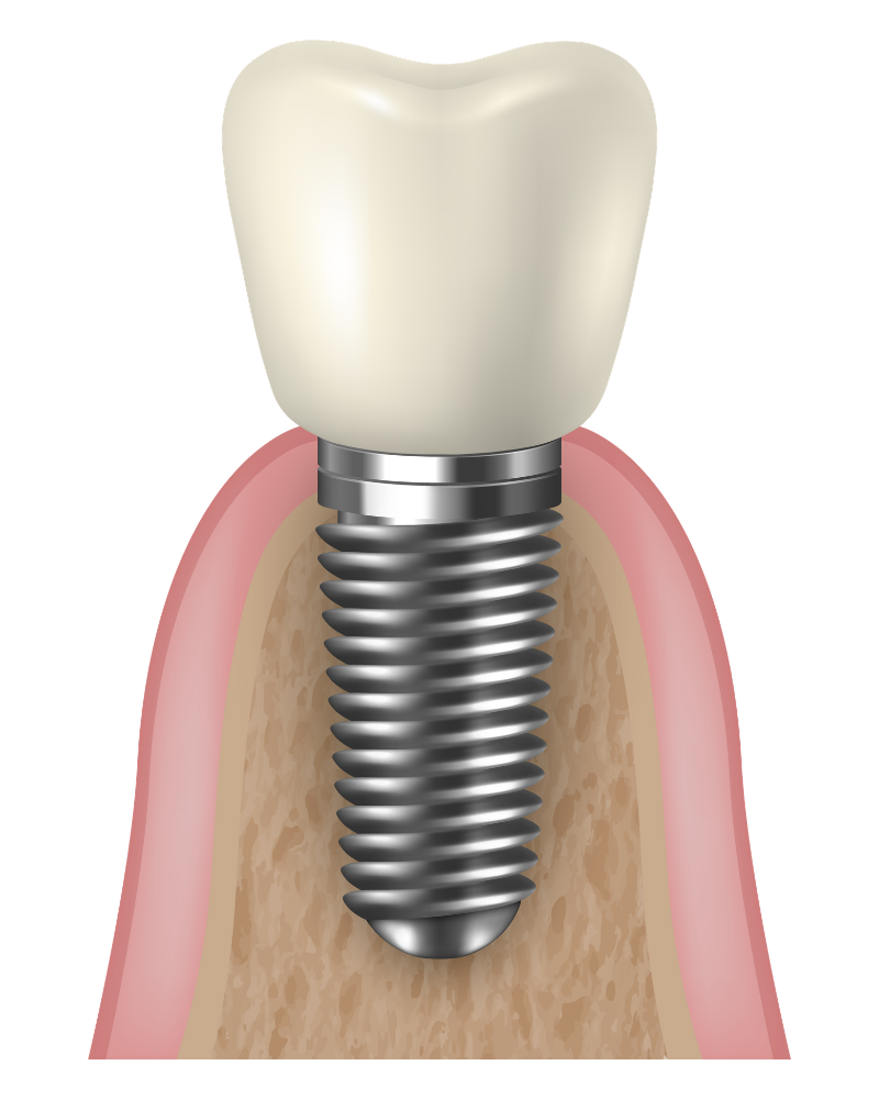 Anatomy of a Dental Implant
